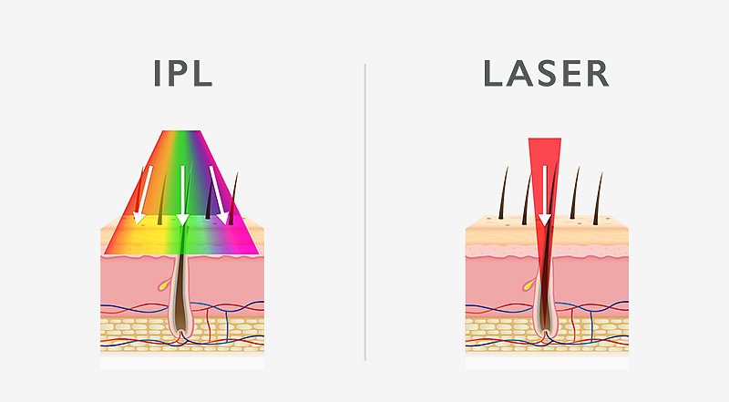 depilator IPL vs. depilator laserowy